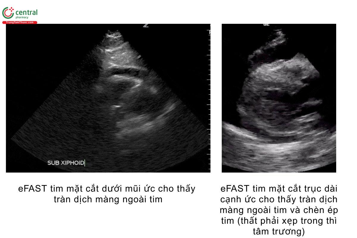eFAST tim mặt cắt dưới mũi ức cho thấy tràn dịch màng ngoài tim, eFAST tim mặt cắt trục dài cạnh ức cho thấy tràn dịch màng ngoài tim và chèn ép tim (thất phải xẹp trong thì tâm trương)