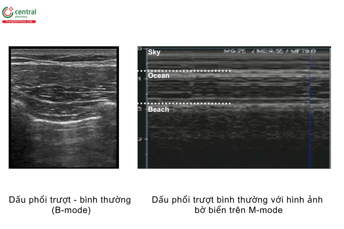 Dấu phổi trượt - bình thường (B-mode), dấu phổi trượt bình thường với hình ảnh bờ biển trên M-mode