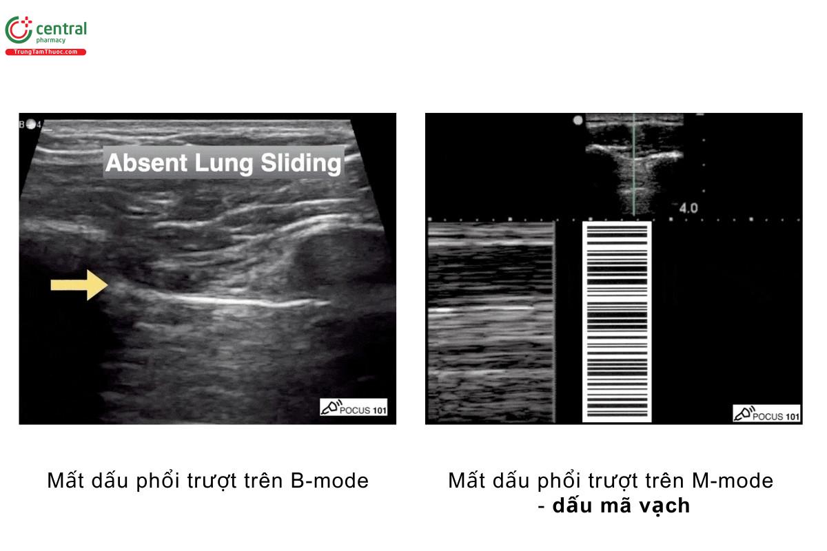 Mất dấu phổi trượt trên B-mode, mất dấu phổi trượt trên M-mode - dấu mã vạch