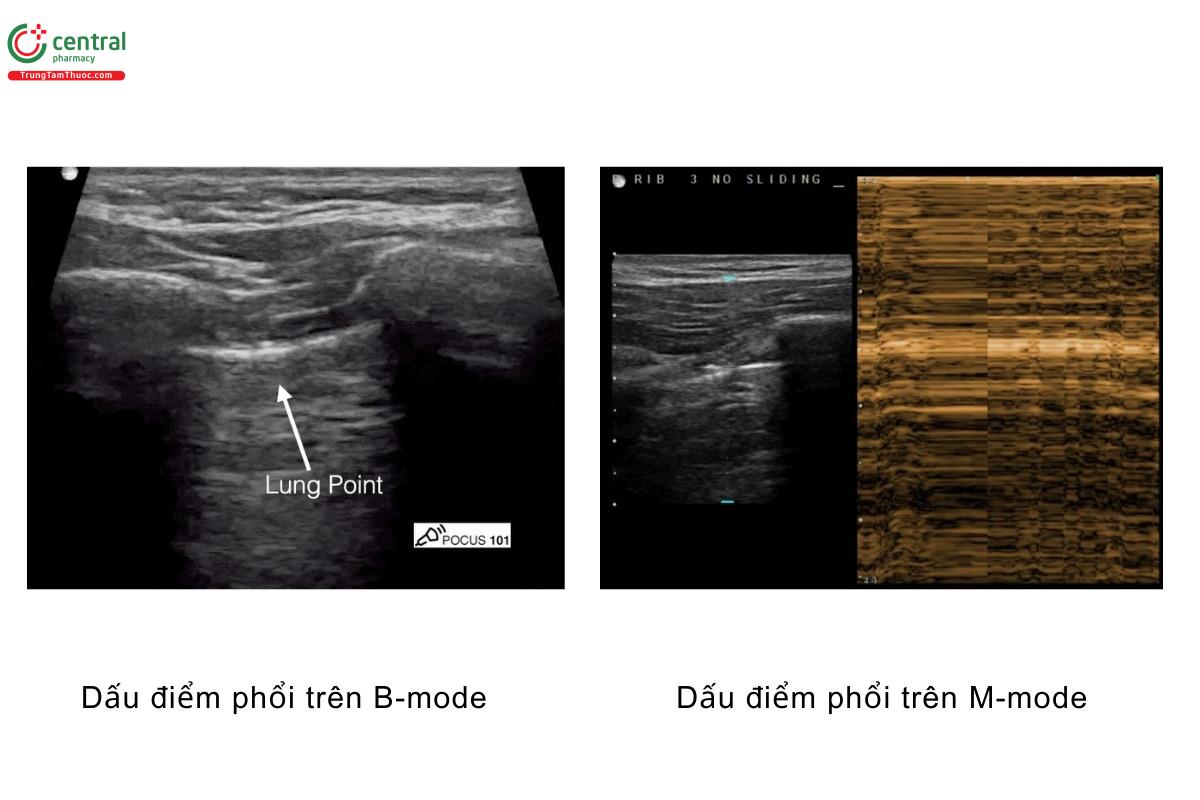 Dấu điểm phổi trên B-mode, dấu điểm phổi trên M-mode