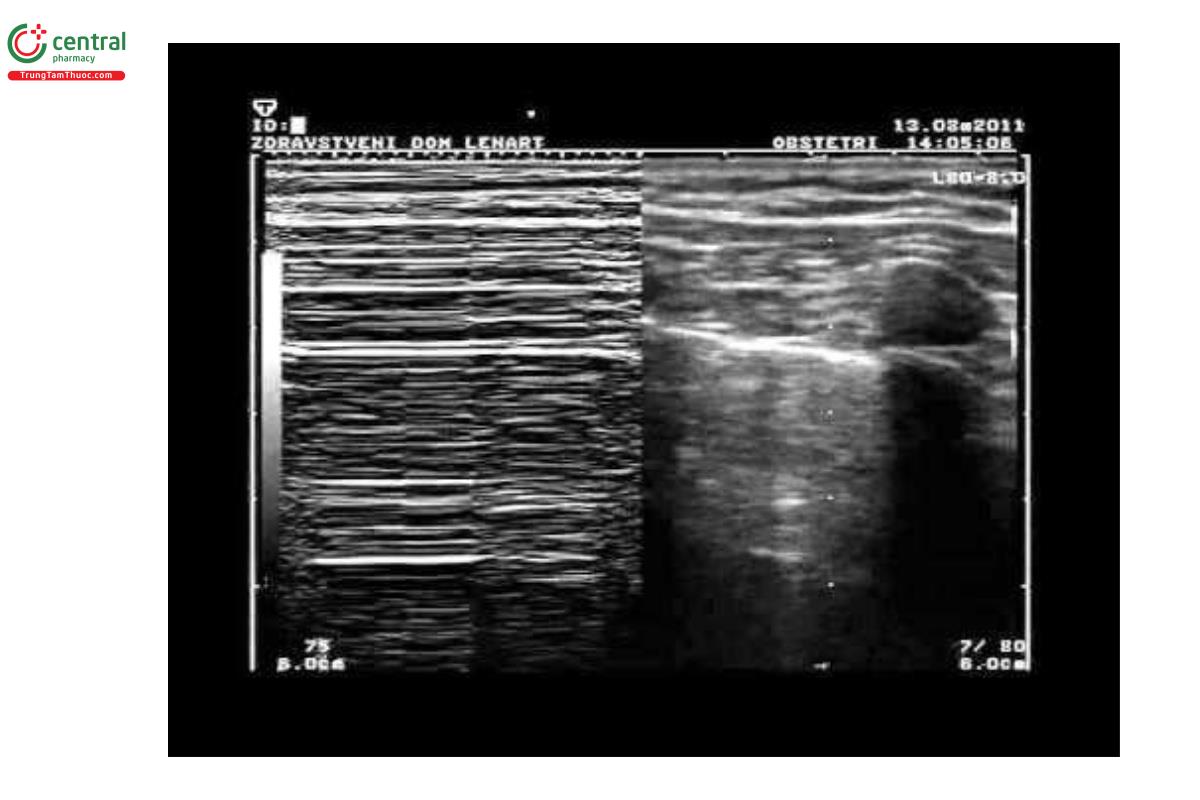 Dấu điểm phổi (các bạn nên xem ở tốc độ 0,5-0,75 sẽ dễ thấy tương quan giữa B-mode và M-mode hơn)