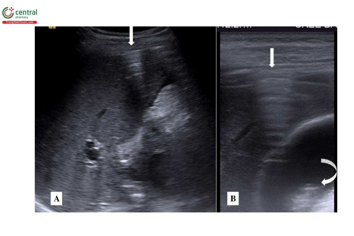 Dấu dải tăng sáng phúc mạc (mũi tên thẳng) ở trước gan, cho thấy có khí giữa gan và thành bụng trước