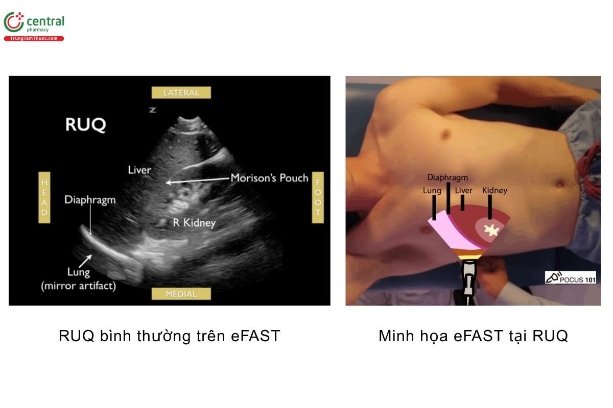 RUQ bình thường trên eFAST