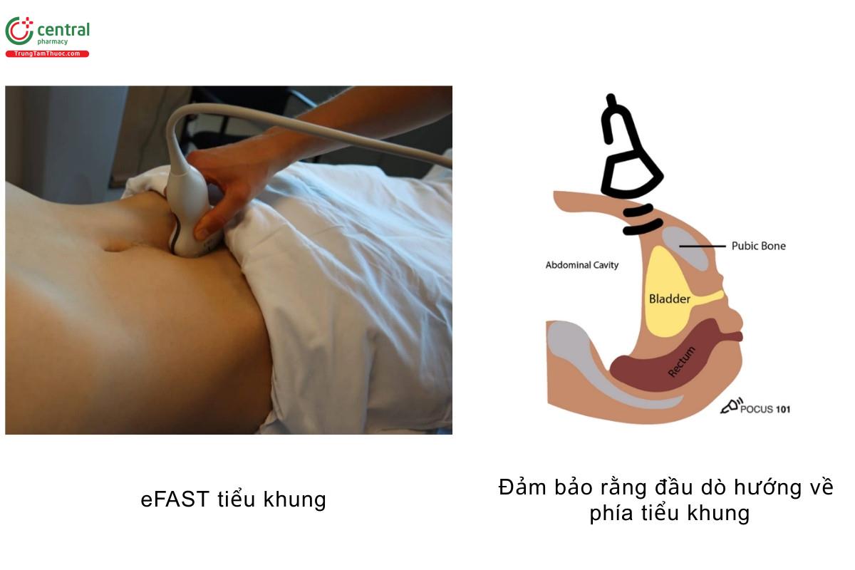 eFAST tiểu khung Đảm bảo rằng đầu dò hướng về phía tiểu khung