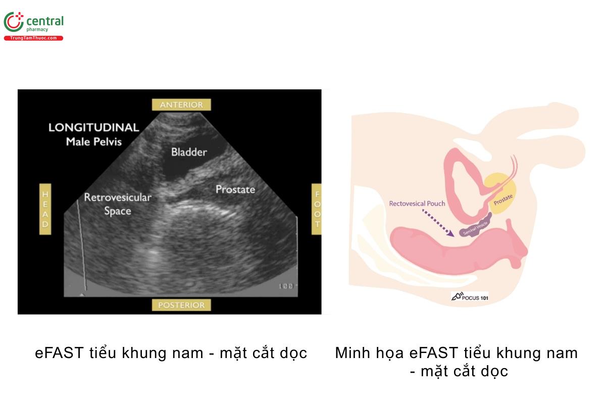 eFAST tiểu khung nam - mặt cắt dọc Minh họa eFAST tiểu khung nam - mặt cắt dọc