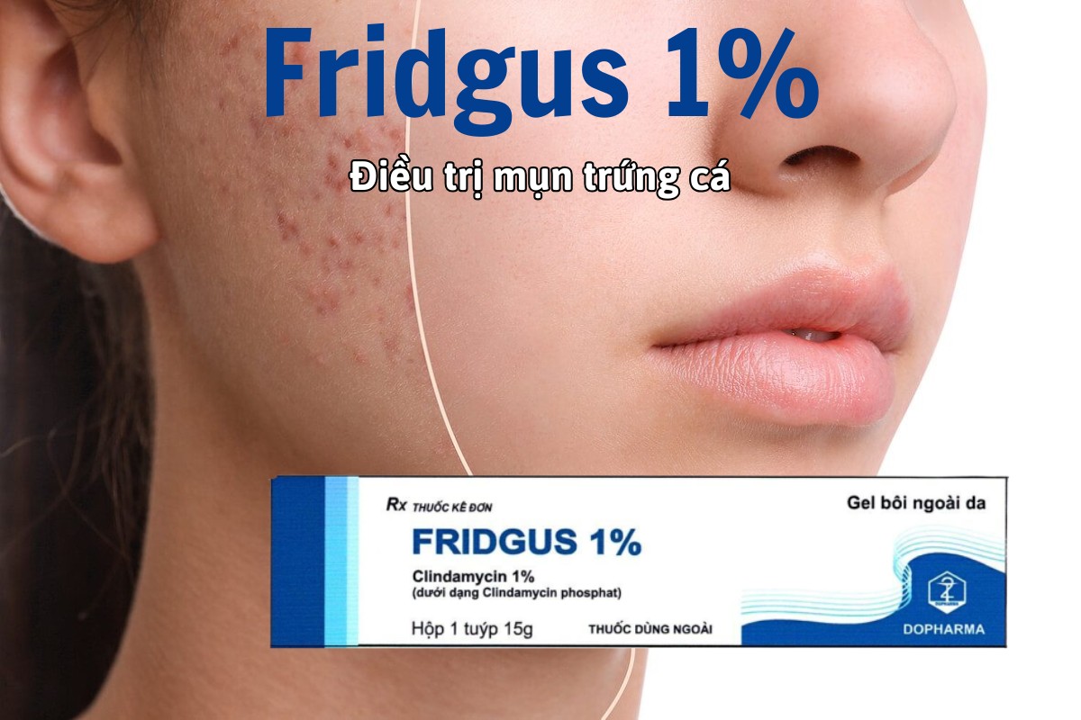 Thuốc Fridgus 1% chỉ định điều trị mụn trứng cá mức độ nhẹ đến trung bình