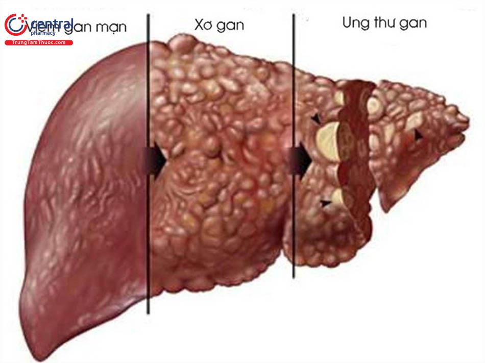 Hình ảnh gan khỏe mạnh và gan bị bệnh