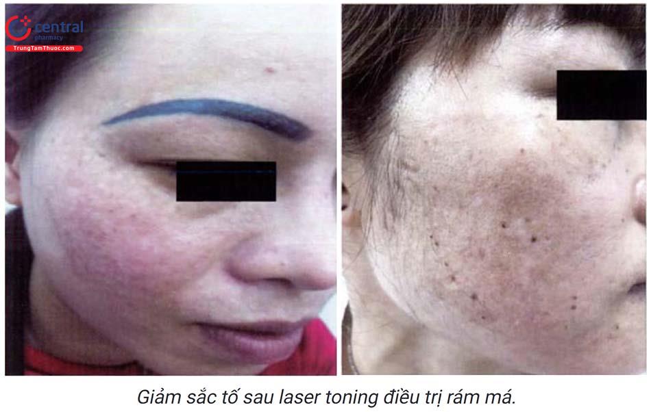 Giảm sắc tố: nguyên nhân, triệu chứng và cách điều trị (phần 2)