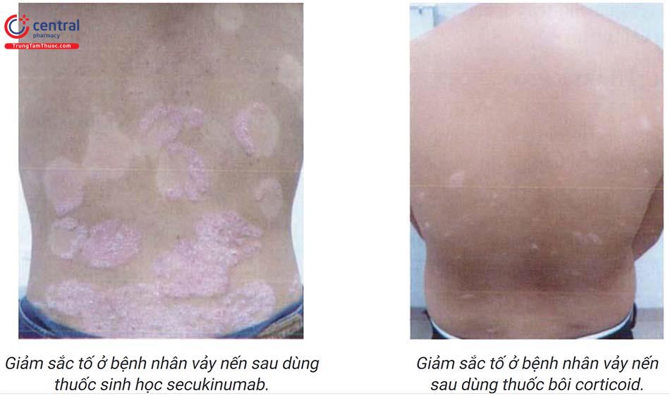 Giảm sắc tố: nguyên nhân, triệu chứng và cách điều trị (phần 2)