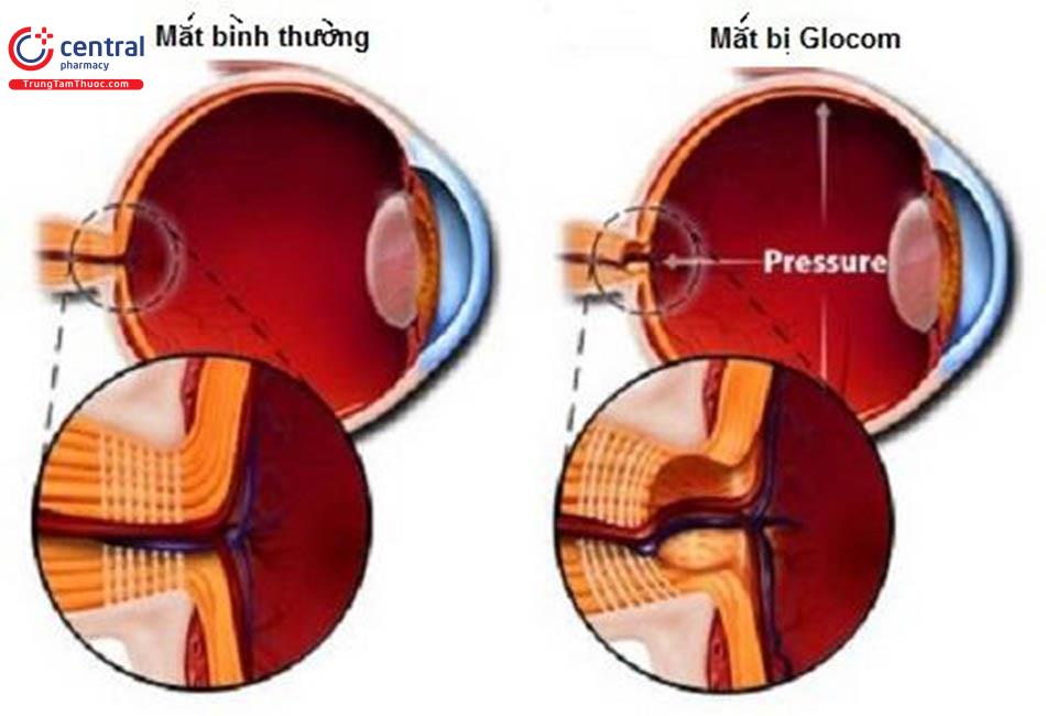 So sánh dây thần kinh thị giác bị tổn thương trong bệnh glocom