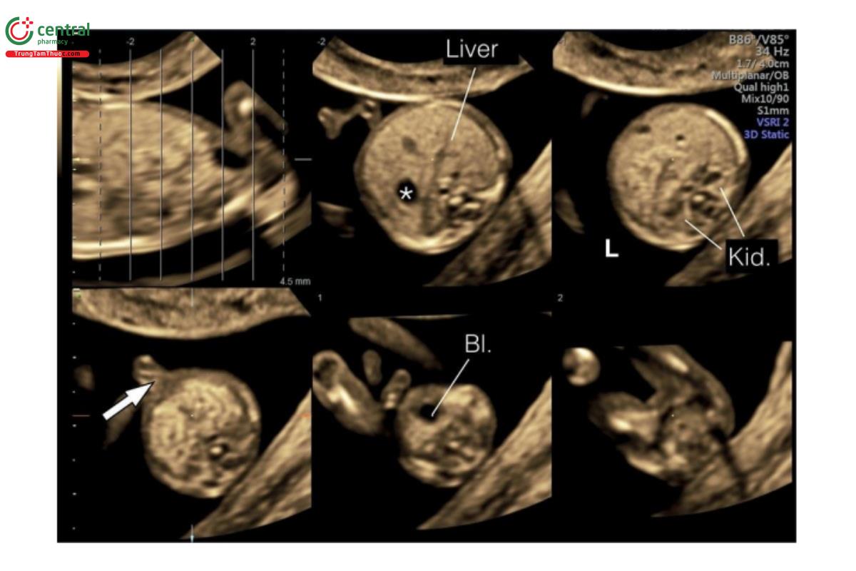 Hình 12.10: Mặt cắt ngang bụng với chế độ cắt lớp ở thai nhi 12 tuần tuổi cho thấy bụng trên, bụng giữa và bụng dưới. Lưu ý, dạ dày (dấu hoa thị) và gan ở bụng trên, thận (Kid.) và dây rốn cắm vào (mũi tên) ở bụng giữa, và bàng quang (Bl.) ở bụng dưới. L, trái. 