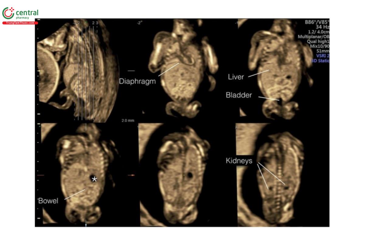 Hình 12.11: Mặt cắt vành ở chế độ cắt lớp của ngực và bụng thai nhi 13 tuần tuổi. Ở mặt cắt này, có thể thấy cơ hoành, gan, dạ dày (dấu hoa thị), ruột, thận và bàng quang. Lưu ý, ruột hồi âm dày do tiếp cận qua ngả âm đạo. 