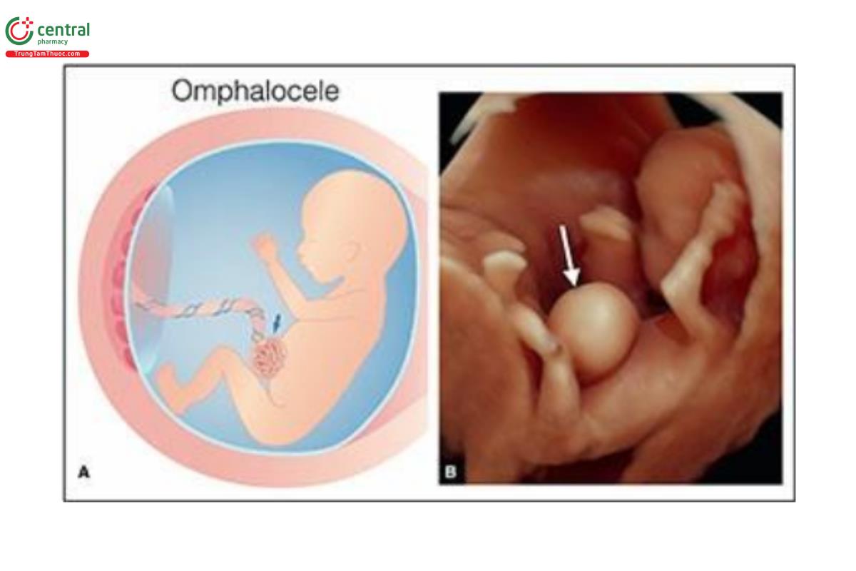 Hình 12.12: Hình vẽ minh họa (A) và hình ảnh siêu âm 3D tương ứng ở chế độ bề mặt của thai nhi 12 tuần tuổi có thoát vị rốn (mũi tên). Lưu ý ở A, túi thoát vị rốn bao phủ các cơ quan trong ổ bụng nhô ra (ruột, có hoặc không có gan), với dây rốn cắm vào đỉnh túi thoát vị. Không thấy dây rốn ở B, vì bị các chi dưới che khuất. 