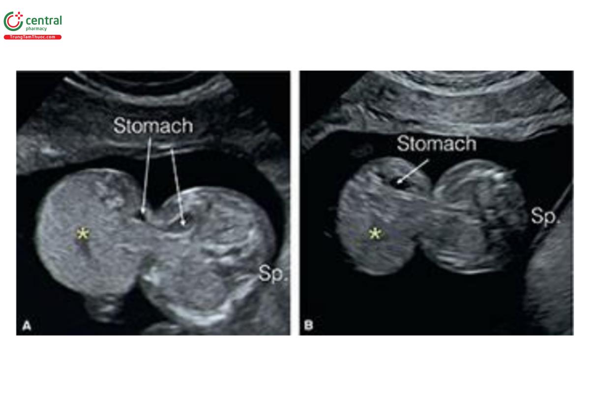 Hình 12.15: Mặt cắt ngang thành bụng ở mức dây rốn cắm vào ở 2 thai nhi 12 (A) và 13 (B) tuần tuổi. Lưu ý, thoát vị rốn lớn (dấu hoa thị) với thành phần gan và ruột ở cả 2 thai nhi. Ở thai nhi A, một phần dạ dày nằm trong túi thoát vị, trong khi ở thai nhi B, dạ dày nằm hoàn toàn trong túi thoát vị. Sp, cột sống. 
