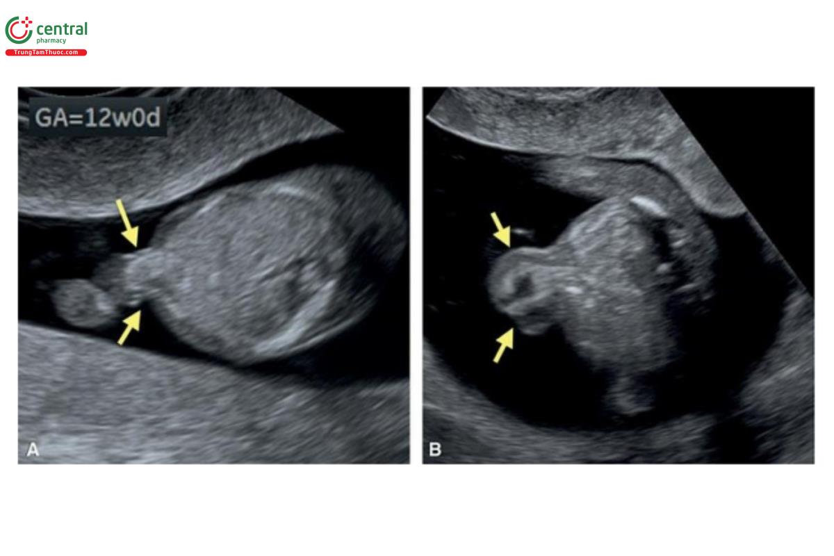 Hình 12.16: Mặt cắt ngang thành bụng ở mức dây rốn cắm vào ở 2 thai nhi 12 (A) và 13 (B) tuần tuổi. Lưu ý, thoát vị rốn nhỏ (các mũi tên) ở thai nhi A và B, chỉ chứa ruột. Cả 2 thai nhi đều bị trisomy 18.