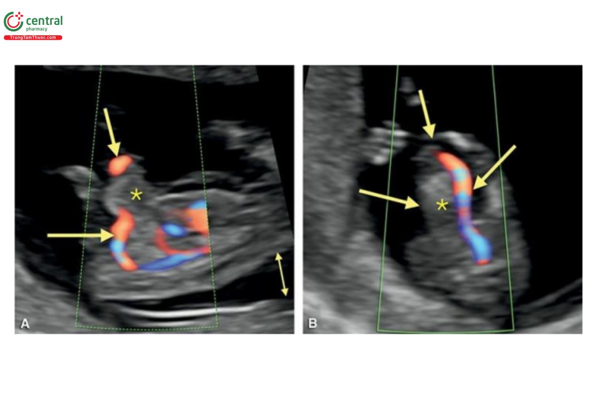 Hình 12.17: Mặt cắt dọc (A) và ngang (B) bụng giữa với Doppler màu ở thai nhi 12 tuần tuổi bị trisomy 18. Lưu ý, thoát vị rốn nhỏ (dấu hoa thị) ở A và B và độ mờ da gáy dày (mũi tên hai đầu) ở A. Doppler màu rất hữu ích vì nó cho thấy dây rốn xuất phát từ đỉnh túi thoát vị rốn ở A (mũi tên) (so sánh với Hình 12.12A) và động mạch rốn duy nhất (single umbilical artery) ở B. (mũi tên).