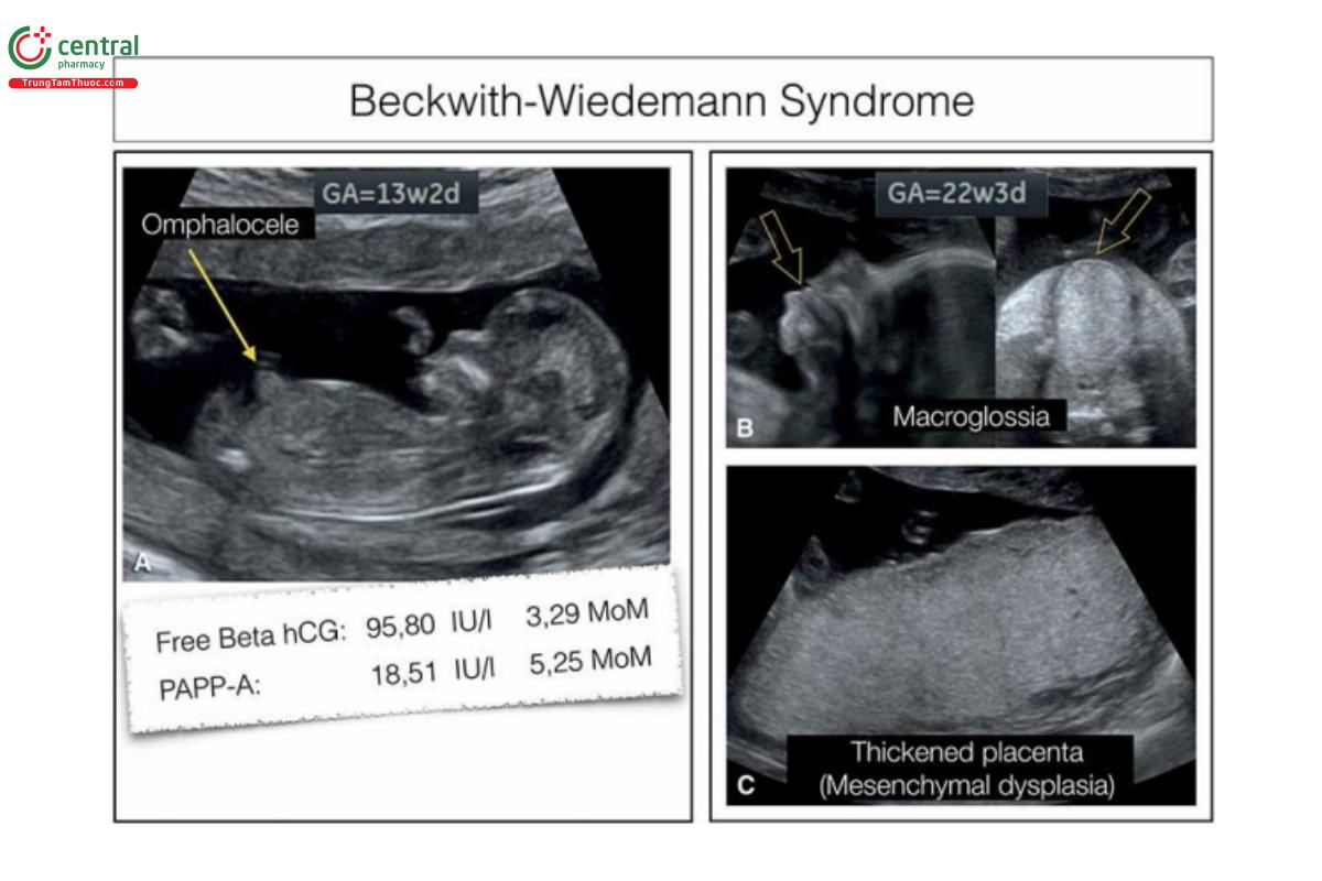 Hình 12.18: Thai nhi mắc hội chứng Beckwith–Wiedemann. Lúc 13 tuần tuổi, phát hiện thoát vị rốn nhỏ chứa ruột, như cho thấy ở mặt cắt dọc giữa của thai nhi ở A. Ngoài ra, β-hCG tự do và PAPP-A (protein-A huyết tương liên quan đến thai kỳ) tăng cao. Sinh thiết gai nhau cho thấy nhiễm sắc thể đồ bình thường. Lúc 22 tuần tuổi, không còn thấy thoát vị rốn nhưng lại phát hiện lưỡi to ở mặt cắt dọc giữa và mặt cắt vành vành của mặt ở B (mũi tên, và bánh nhau cũng dày gợi ý loạn sản trung mô (C). Các dấu hiệu trên siêu âm gợi ý hội chứng Beckwith-Wiedemann, được xác nhận sau sinh bằng xét nghiệm di truyền học phân tử