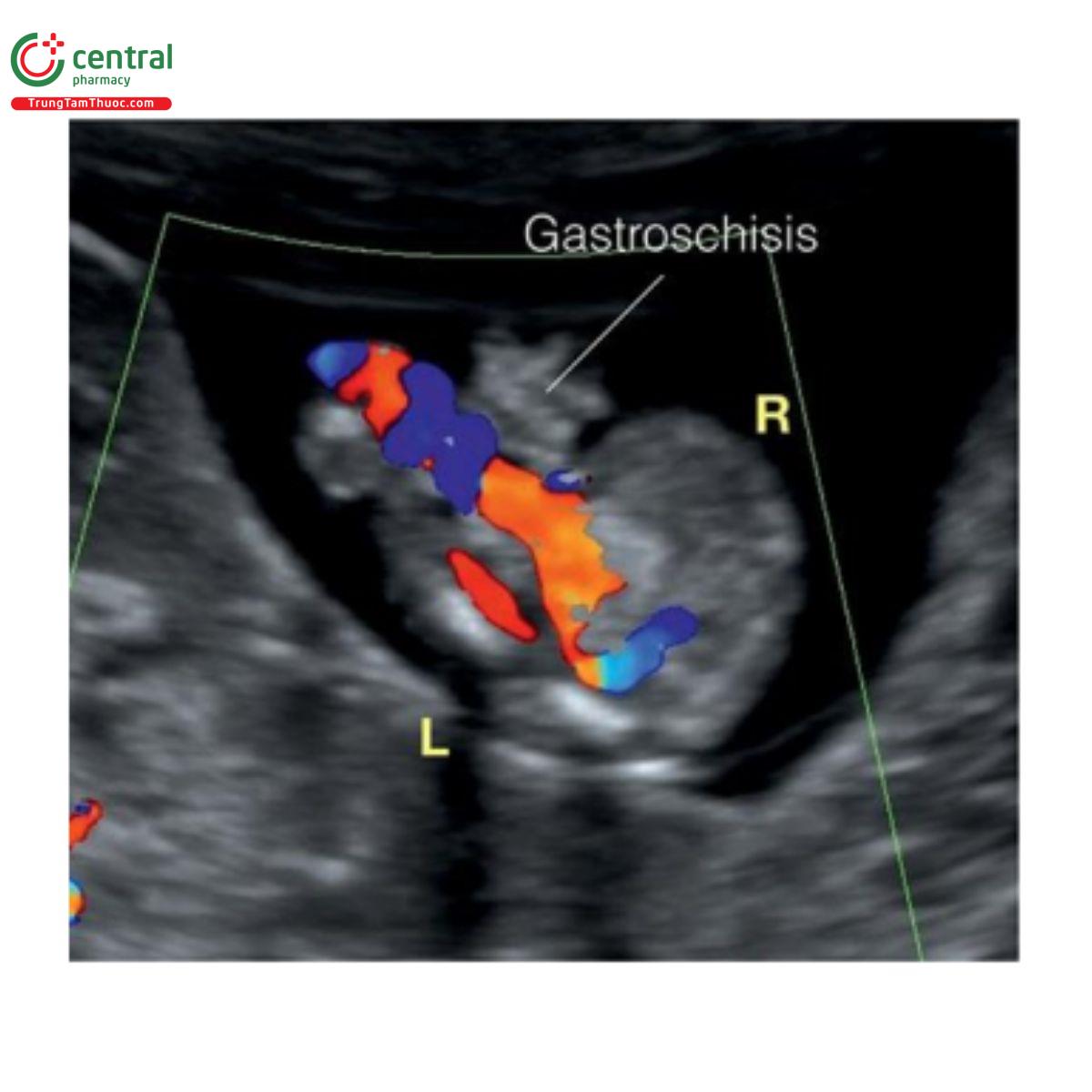  Hình 12.21: Mặt cắt ngang bụng thai nhi 12 tuần tuổi với Doppler màu bị hở thành bụng. Lưu ý, trong hở thành bụng, dây rốn thường cắm vào bụng bên trái. L, trái; R, phải.