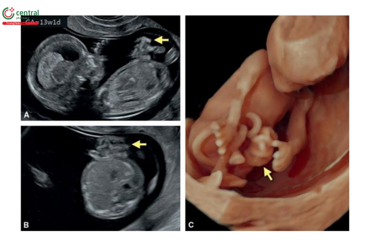 Hình 12.23: Mặt cắt dọc bên (A) và ngang (B) trên siêu âm 2D và siêu âm 3D tương ứng ở chế độ bề mặt (C) của một thai nhi 13 tuần tuổi bị hở thành bụng. Lưu ý, ruột thoát vị (các mũi tên) hồi âm dày ở A và B. C: Các quai ruột tự do trên siêu âm 3D. Trong hở thành bụng, dãn ruột được thấy rõ đầu tiên trong quý 2.