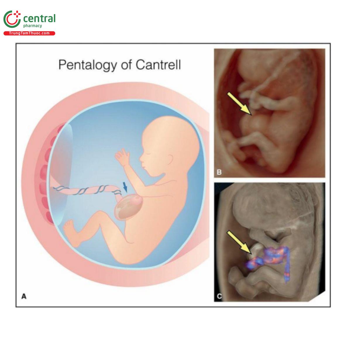 Hình 12.24: Hình vẽ minh họa (A) và hình ảnh siêu âm 3D tương ứng ở chế độ bề mặt (B) và glass-body mode (C) ở thai nhi 11 tuần tuổi có ngũ chứng Cantrell. Lưu ý, thoát vị rốn cao với tim lạc chỗ (mũi tên). Tim lạc chỗ có thể là bán phần hoặc toàn phần (như trong trường hợp này). Ngũ chứng Cantrell thường kèm theo bất thường tim (xem văn bản để biết thêm chi tiết).