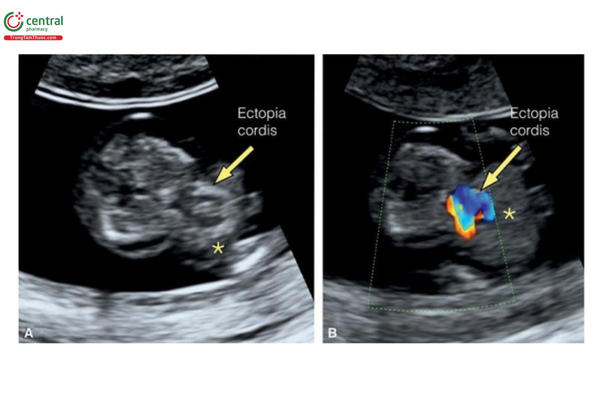 Hình 12.25: Mặt cắt ngang ngực trên siêu âm 2D (A) và Doppler màu (B) ở thai nhi 11 tuần tuổi có ngũ chứng Cantrell. Lưu ý, thoát vị rốn (dấu hoa thị) với tim lạc chỗ (mũi tên).