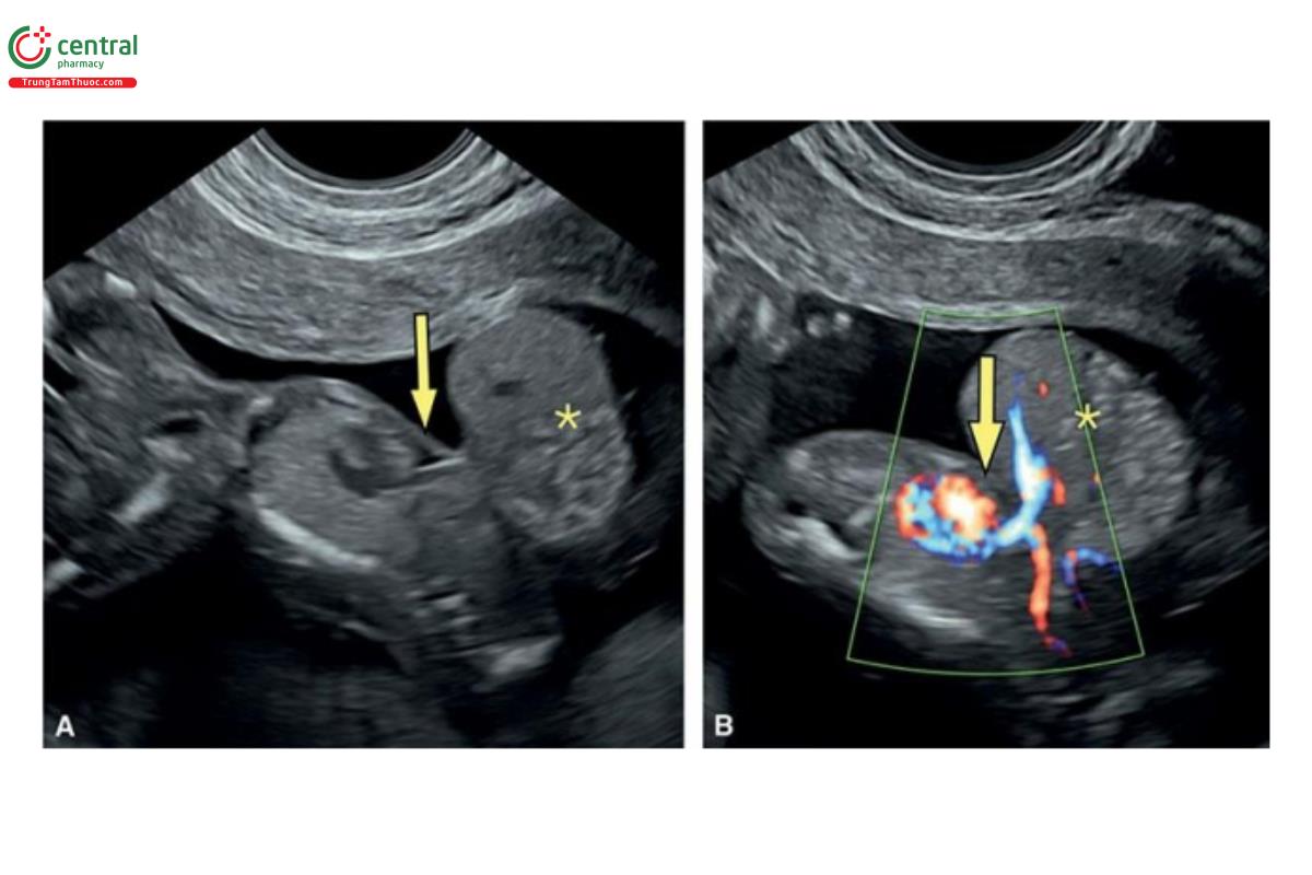  Hình 12.26: Mặt cắt dọc của ngực và bụng trên siêu âm 2D (A) và Doppler màu (B) ở thai nhi 13 tuần tuổi có ngũ chứng Cantrell nhẹ với tim lạc chỗ bán phần. Lưu ý, thoát vị rốn cao (dấu hoa thị), tim bị dịch chuyển xuống dưới, khiếm khuyết màng ngoài tim và khiếm khuyết phía trước ngực (mũi tên).