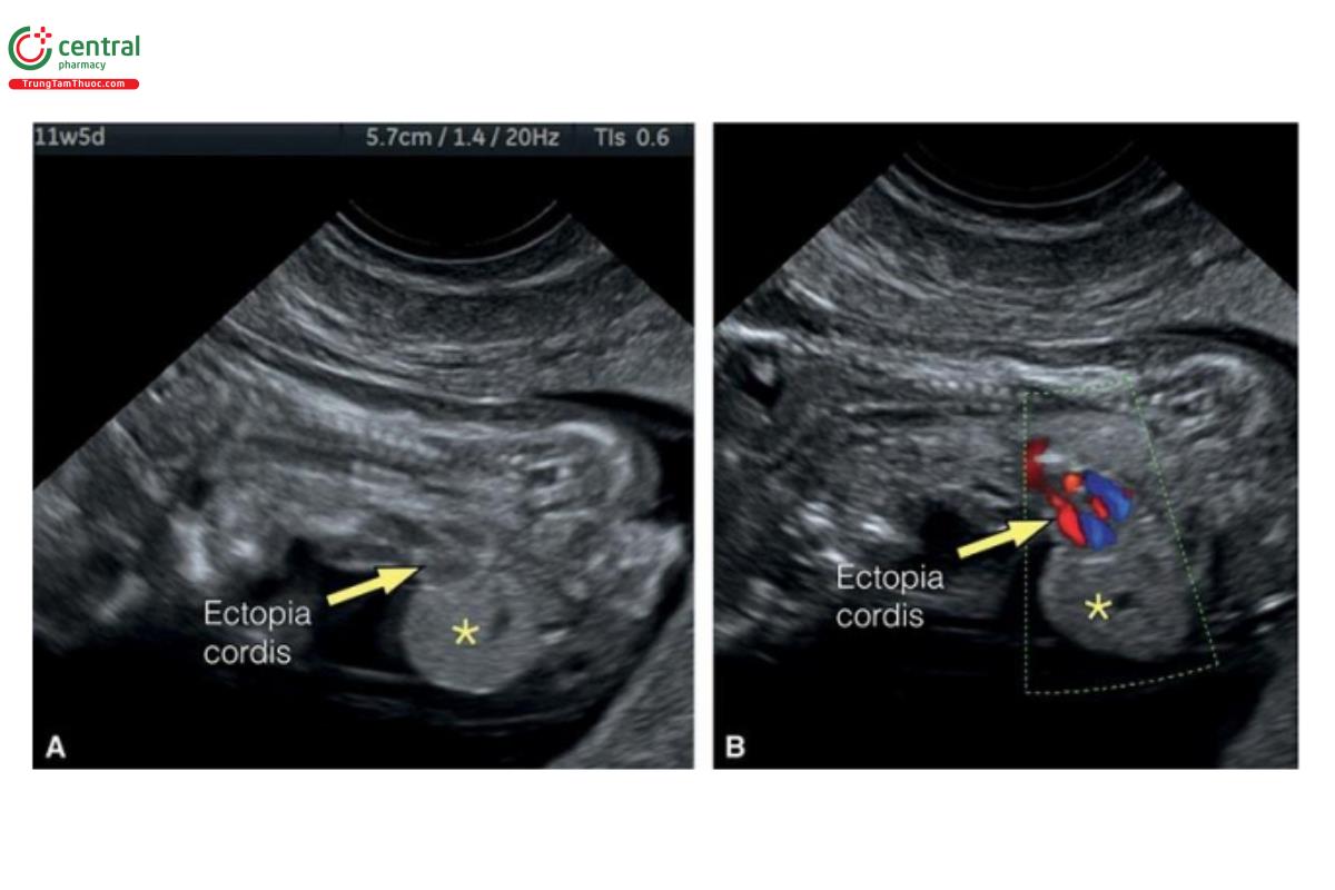 Hình 12.27: Mặt cắt dọc của ngực và bụng trên siêu âm 2D (A) và Doppler màu (B) ở thai nhi 11 tuần tuổi có ngũ chứng Cantrell. Lưu ý, có thoát vị rốn cao (dấu hoa thị) với tim lạc chỗ (mũi tên).