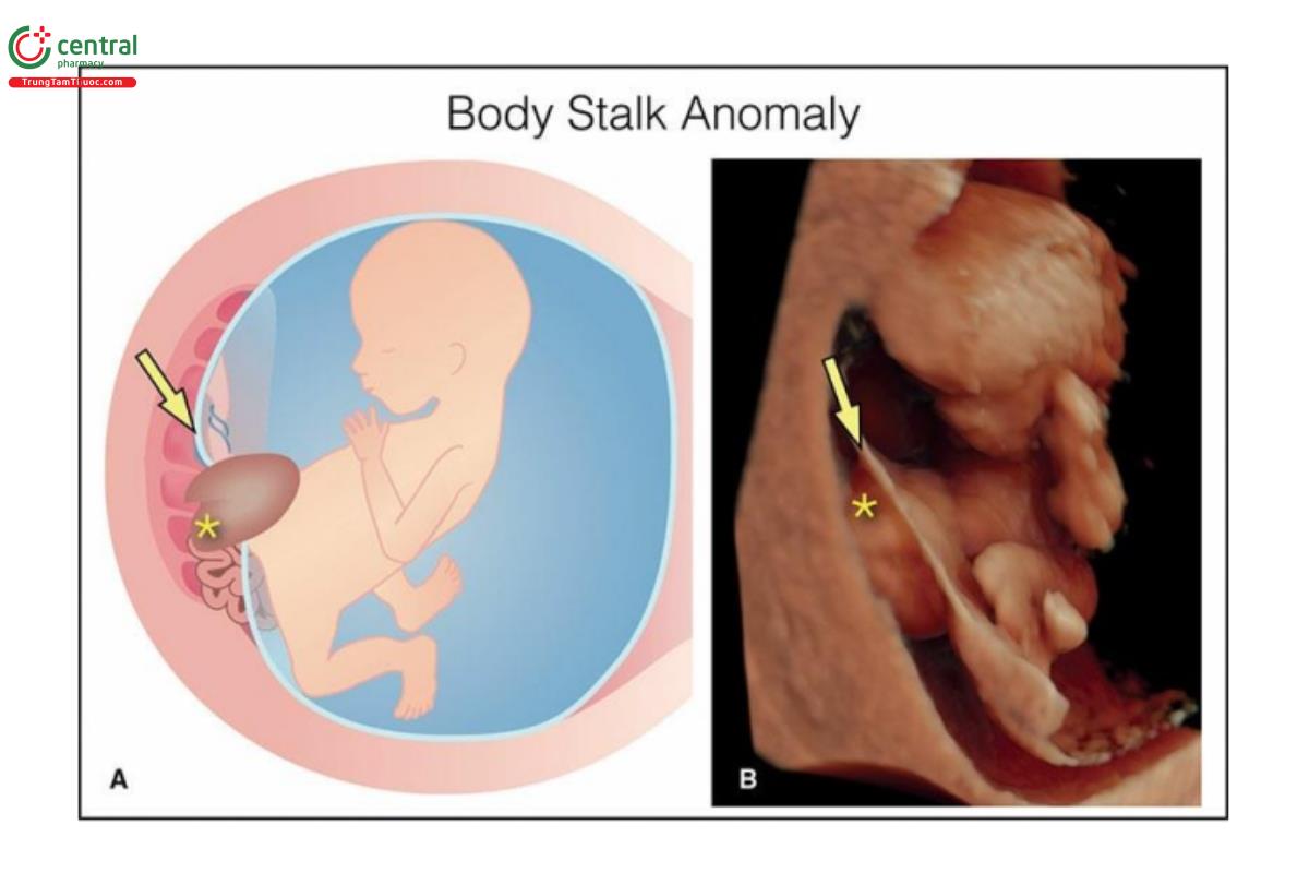Hình 12.29: Hình vẽ minh họa (A) và hình ảnh siêu âm 3D tương ứng ở chế độ bề mặt (B) ở thai nhi 11 tuần tuổi có bất thường phức hợp cơ thể. Lưu ý, thấy một khiếm khuyết lớn ở thành bụng trước, gần như không có dây rốn. Thai nhi dính vào nhau thai, và toàn bộ cơ thể bị biến dạng nghiêm trọng (xem thêm Hình 12.30). Cũng cần lưu ý, gan và ruột của thai nhi (dấu hoa thị) nằm ngoài khoang ối. Các mũi tên chỉ vào màng ối. 