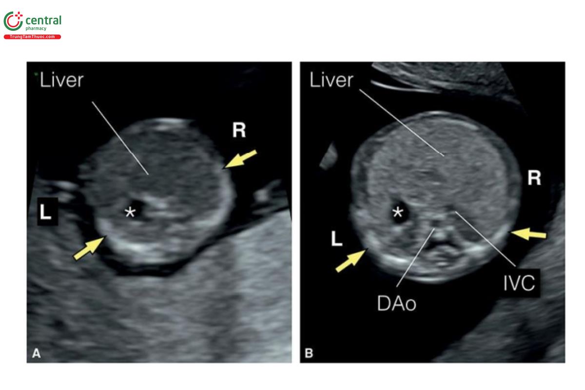 Hình 12.3: Mặt cắt ngang bụng trên của 2 thai nhi 13 tuần tuổi. Thai nhi ở A được siêu âm qua thành bụng và thai nhi ở B qua ngả âm đạo. Lưu ý, thấy dạ dày chứa đầy dịch (dấu hoa thị) ở vùng bụng trên bên trái ở A và B. Thấy các xương sườn (mũi tên) ở hai bên cùng với gan và tĩnh mạch chủ dưới (IVC) ở bụng bên phải (R). Động mạch chủ xuống (DAo) ở phía sau và bên trái IVC. Hình ảnh thai nhi B có độ phân giải cao hơn với cách tiếp cận qua ngả âm đạo, do đó, giúp thấy rõ IVC và DAo. L, trái. 