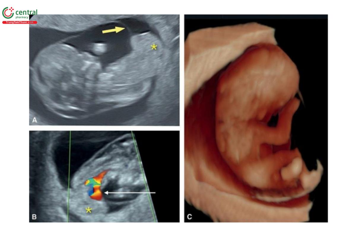 Hình 12.30: Siêu âm 2D thang xám (A) và Doppler màu (B) cùng với siêu âm 3D tương ứng ở chế độ bề mặt (C) ở thai nhi 11 tuần tuổi có bất thường phức hợp cơ thể. Lưu ý, gan nằm ngoài khoang ối (dấu hoa thị ở A và B). Mũi tên màu vàng chỉ vào màng ối ở A. Ngoài ra, còn thấy tim lạc chỗ ở B trên Doppler màu (mũi tên dài màu trắng). Trên siêu âm 3D, thấy cơ thể biến dạng ở C.