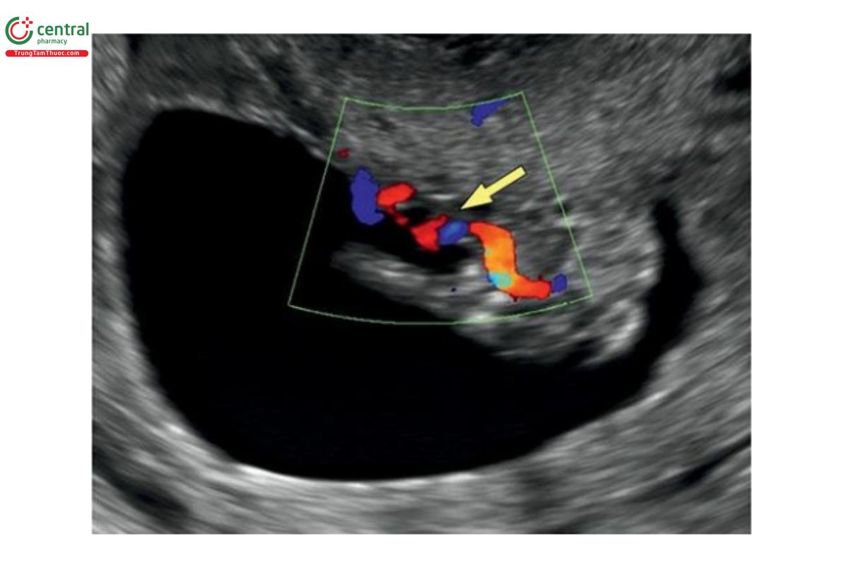 Hình 12.31: Mặt cắt ngang bụng với Doppler màu ở thai nhi 12 tuần tuổi có bất thường phức hợp cơ thể. Lưu ý, dây rốn ngắn (mũi tên). Thai nhi cũng có nhiều dị tật phức tạp.