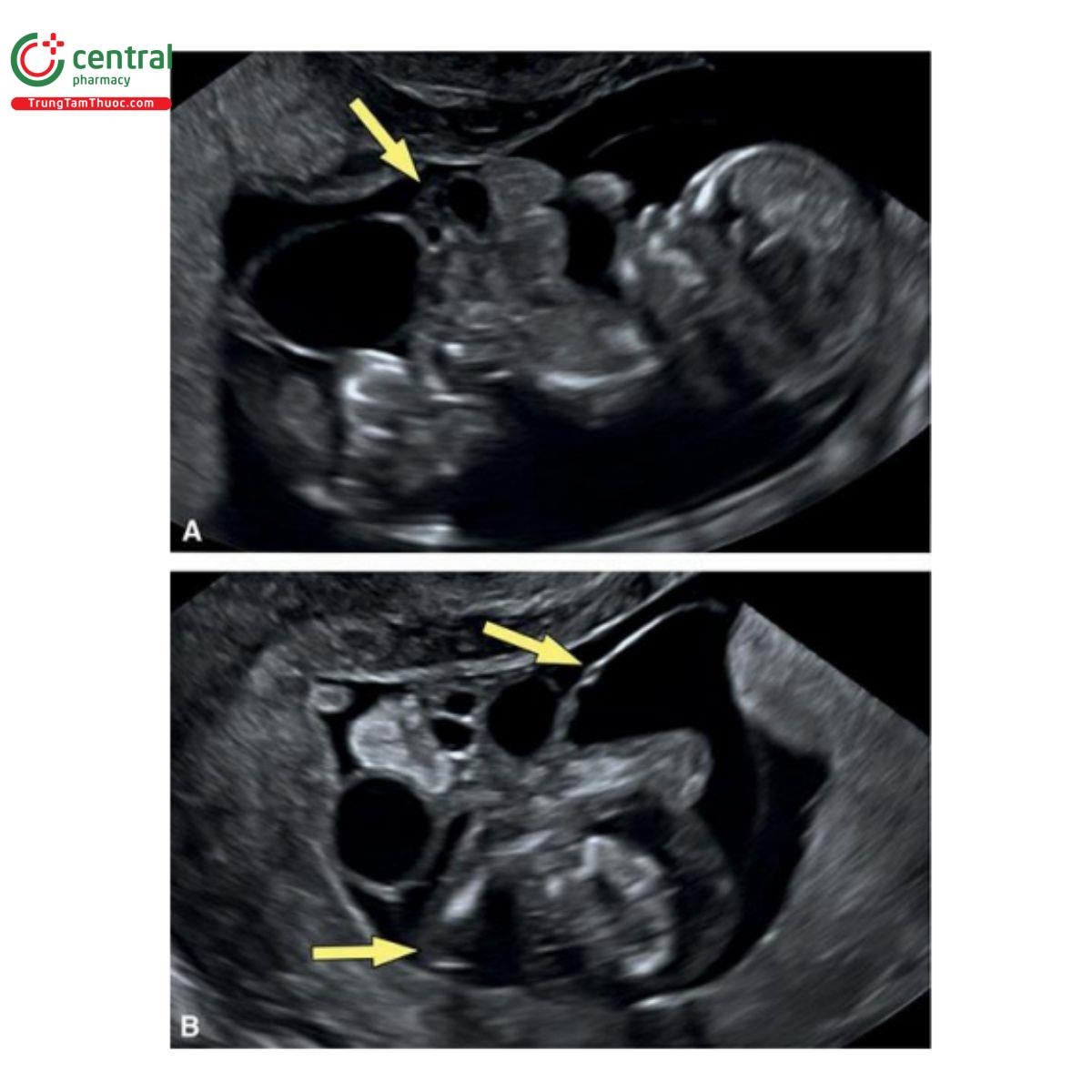 Hình 12.32: Hình ảnh siêu âm của thai nhi 12 tuần tuổi có OEIS. OEIS bao gồm thoát vị rốn, lộn bàng quang, không lỗ hậu môn và khiếm khuyết cột sống. OEIS là dạng bất thường phức hợp cơ thể nghiêm trọng nhất với các bộ phận của cơ thể bị thiếu và các bộ phận khác nằm ngoài khoang ối. Lưu ý, có sự biến dạng cơ thể nghiêm trọng và một phần đáng kể phôi thai nằm ngoài khoang ối ở A và B. Các mũi tên chỉ vào màng ối.  