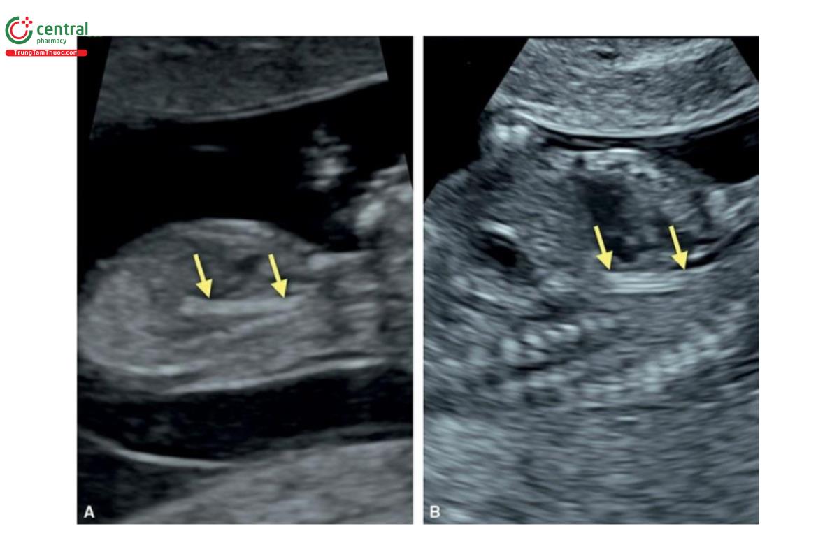 Hình 12.34: Hình ảnh siêu âm mặt cắt dọc bên qua thành bụng (A) và qua ngả âm đạo (B) của ngực và bụng trên ở 2 thai nhi 13 tuần tuổi cho thấy thực quản hồi âm dày (mũi tên). Đầu dò siêu âm độ phân giải cao có thể cho thấy thực quản ở tuổi thai nhỏ.