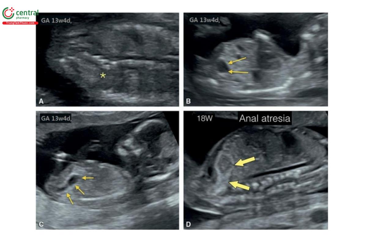 Hình 12.36: Hình ảnh siêu âm của một thai nhi có hội chứng VATER, nghi ngờ đầu tiên lúc 13 tuần tuổi. A: Tật nửa đốt sống (dấu hoa thị) lúc 13 tuần tuổi. B: Một cấu trúc dạng nang ở bụng dưới (mũi tên) lúc 13 tuần tuổi. C: Mặt cắt dọc của bụng và tiểu khung cho thấy cấu trúc dạng nang là trực tràng dãn với các đường viền hồi âm dày (mũi tên). D: Mặt cắt dọc tiểu khung lúc 18 tuần tuổi cho thấy trực tràng và đại tràng có đường viền tăng âm (mũi tên), gợi ý teo hậu môn (anal atresia). Ruột hồi âm dày đã biến mất khi siêu âm theo dõi sau đó. Sau sinh, xác nhận hội chứng VATER và teo hậu môn.