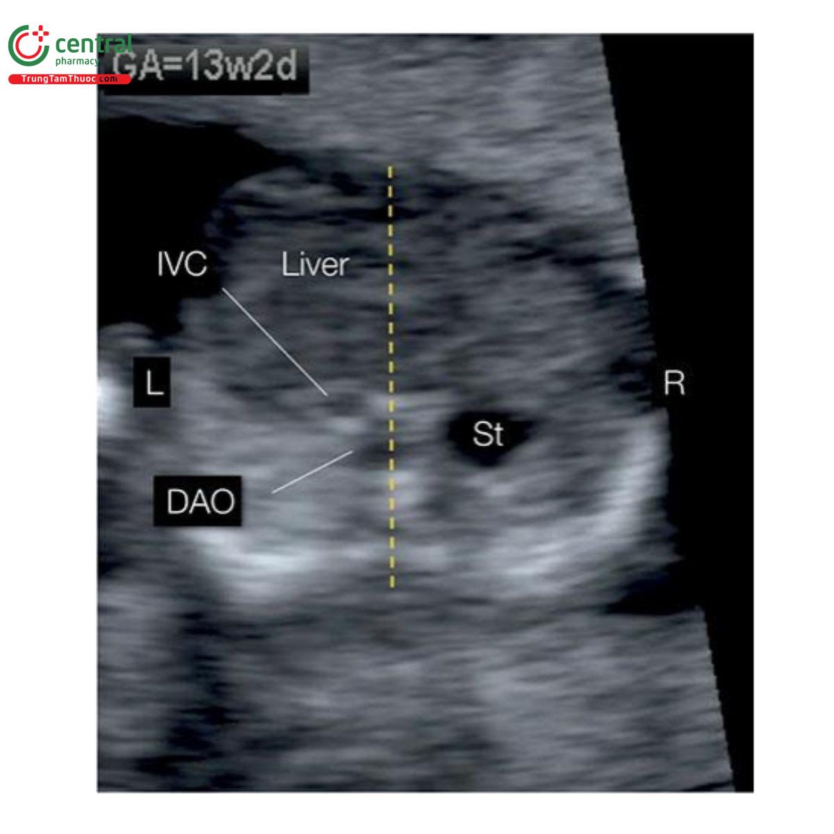 Hình 12.38: Mặt cắt ngang bụng trên của thai nhi 13 tuần tuổi, cho thấy situs bụng bất thường, nghi ngờ đồng dạng bên phải (right isomerism) do dị tật tim phức tạp. Lưu ý, dạ dày ở bên phải (St), trong khi động mạch chủ xuống (DAO), tĩnh mạch chủ dưới (IVC) và gan ở bên trái. L, trái; R, phải.