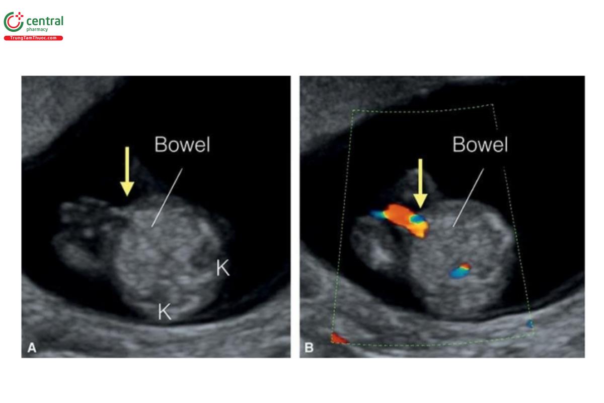 Hình 12.4: Mặt cắt ngang bụng giữa trên siêu âm 2D (A) và Doppler màu (B) ngang mức độ dây rốn cắm vào (mũi tên) ở thai nhi 12 tuần tuổi. Lưu ý, thành bụng trước nguyên vẹn (mũi tên) và ruột thai nhi dường như hồi âm hơn một chút so với mô xung quanh. Thấy cả 2 thận (K) ở bụng sau ở A. 