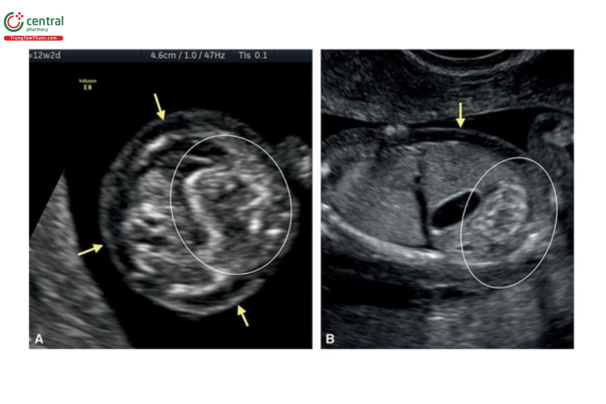 Hình 12.40: Mặt cắt ngang (A) lúc 12 tuần tuổi và mặt cắt dọc bên (B) lúc 13 tuần tuổi ở 2 thai nhi có ruột tăng âm (hình tròn) và trisomy 21. Lưu ý, ruột sáng như xương và phù da (mũi tên) ở cả 2 thai nhi. Trong trisomy 21, ruột tăng âm hiếm khi là một dấu hiệu đơn độc.