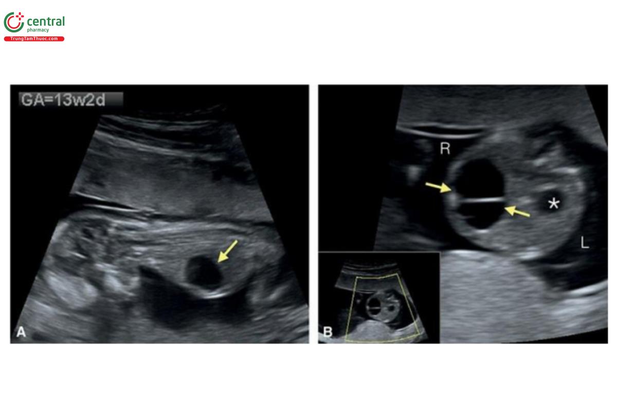 Hình 12.42: Mặt cắt dọc (A) và ngang (B) của thai nhi 13 tuần tuổi với một nang lớn trong gan (mũi tên). Thấy dạ dày ở B (dấu hoa thị). Quản lý mong đợi (Expectant management) và siêu âm theo dõi lúc 16 tuần tuổi (Hình 12.43) cho thấy nang đã thoái triển. L, trái; R, phải.