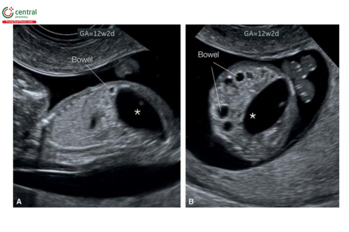 Hình 12.44: Mặt cắt dọc (A) và ngang (B) của thai nhi 12 tuần tuổi có bàng quang lớn (dấu hoa thị) và dãn các quai ruột liền kề có thành hồi âm dày. Các dấu hiệu này gợi ý tắc ruột và rò vào ổ nhớp (fistula into a cloaca). Xem Hình 12.45 và 12.46.