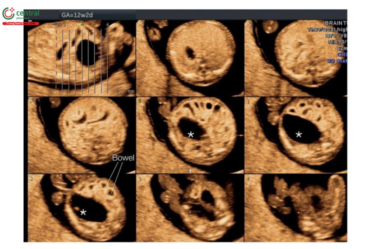 Hình 12.45: Siêu âm 3D ở chế độ hiển thị cắt lớp của một thai nhi 12 tuần tuổi có bàng quang lớn (dấu hoa thị) và các quai ruột dãn (giống như thai nhi ở Hình 12.44). Lưu ý, có nhiều quai ruột dãn với đường viền hồi âm dày.