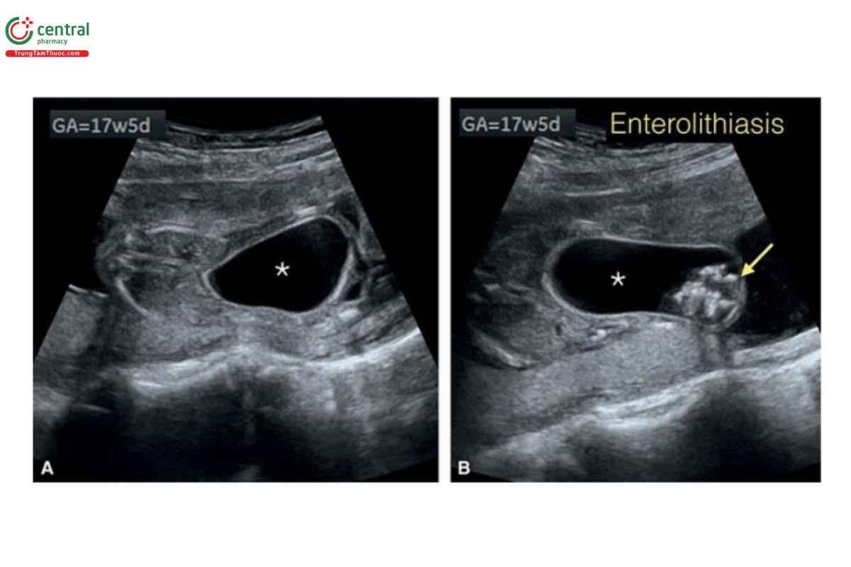 Hình 12.46: Mặt cắt ngang (A và B) của cùng một thai nhi như trong Hình 12.44 và 12.45, lúc này được 17 tuần tuổi. Lưu ý, có dãn ổ nhớp (dấu hoa thị) với thành hồi âm dày. B: Có sỏi ruột với các mảnh hồi âm dày trong nang (mũi tên).