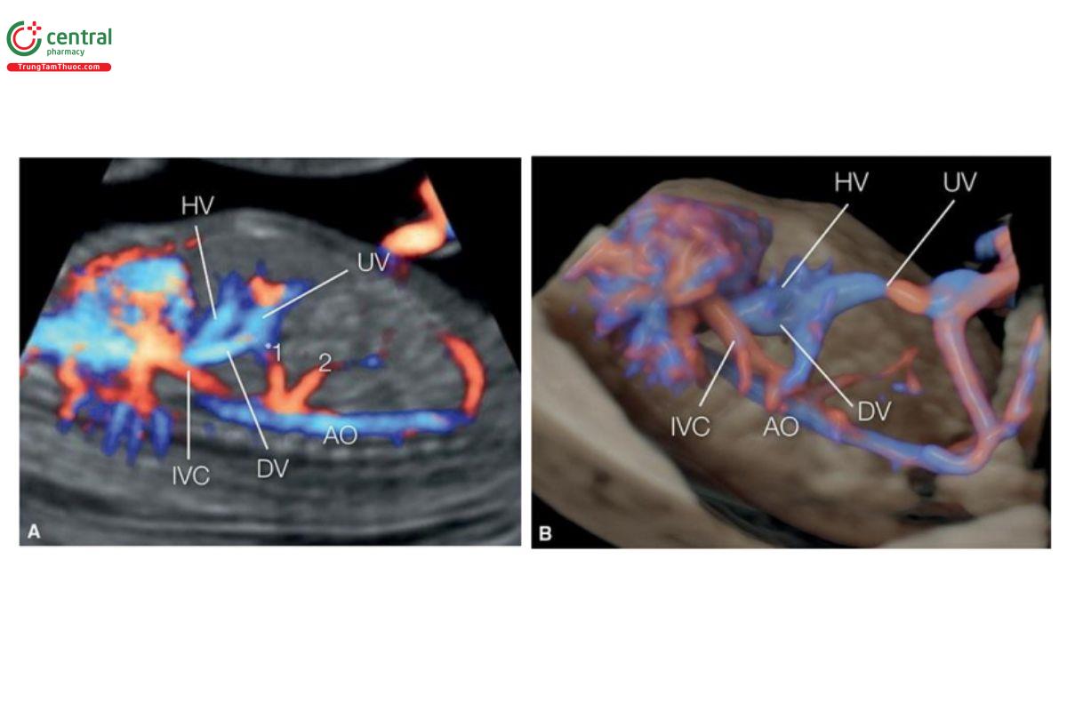 Hình 12.47: Mặt cắt dọc của ngực và bụng với Doppler màu (A) và siêu âm 3D + glass-body mode (B) ở một thai nhi bình thường 13 tuần tuổi, cho thấy hệ thống mạch máu chính trong ổ bụng. Lưu ý, ống tĩnh mạch (DV), tĩnh mạch chủ dưới (IVC) và tĩnh mạch gan trái (HV) hợp nhất trước khi đổ vào tim. Từ động mạch chủ xuống (AO) cho ra động mạch thân tạng (1) và động mạch mạc treo tràng trên (2). UV, tĩnh mạch rốn.