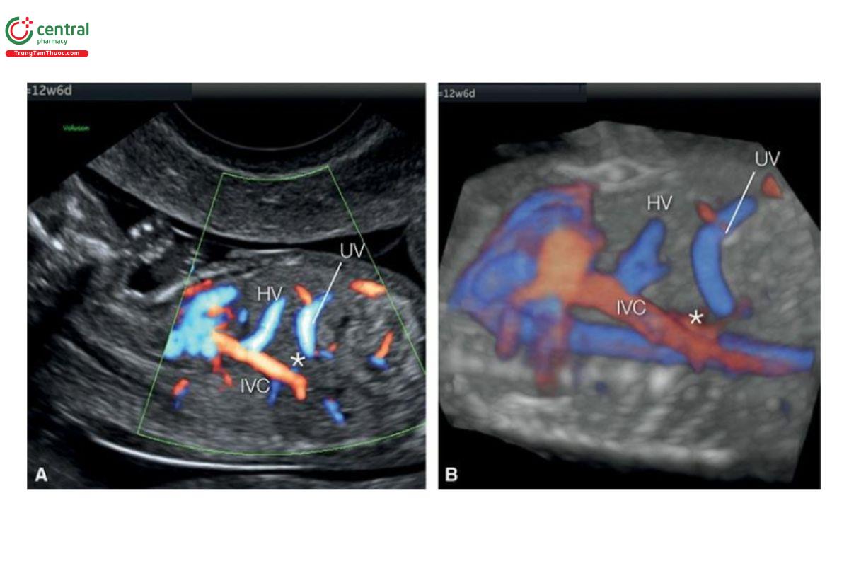 Hình 12.48: Mặt cắt dọc của ngực và bụng với Doppler màu (A) và siêu âm 3D + glass-body mode (B), ở một thai nhi 12 tuần tuổi bị bất sản ống tĩnh mạch (dấu hoa thị). So sánh với mạch máu bình thường trong ổ bụng ở hình 12.47. IVC, tĩnh mạch chủ dưới; HV, tĩnh mạch gan trái; UV, tĩnh mạch rốn.