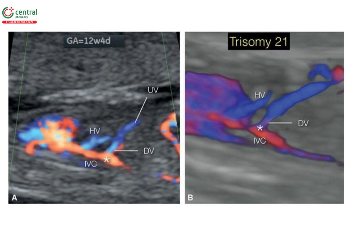 Hình 12.49: Mặt cắt dọc của ngực và bụng với Doppler màu (A) và siêu âm 3D ở glass-body mode (B) ở thai nhi 12 tuần tuổi bị trisomy 21. Lưu ý, ống tĩnh mạch (DV ) đổ trực tiếp vào (dấu hoa thị) tĩnh mạch chủ dưới (IVC) và sự kết nối riêng rẽ của tĩnh mạch gan (HV) với IVC. Thai nhi này cũng có độ mờ da gáy dày (không được hiển thị).