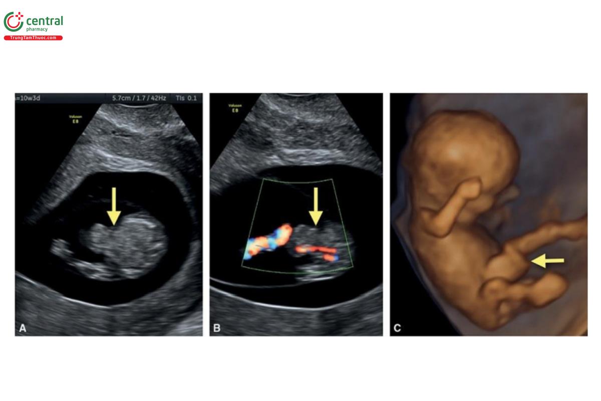 Hình 12.5: Mặt cắt ngang bụng trên siêu âm 2D (A) và Doppler màu (B) của thai nhi 10 tuần tuổi cho thấy thoát vị ruột giữa sinh lý (mũi tên). Trong siêu âm 3D tương ứng ở chế độ bề mặt (surface mode) (C), thoát vị ruột giữa là một khối phồng ở vị trí dây rốn cắm vào ổ bụng (mũi tên).