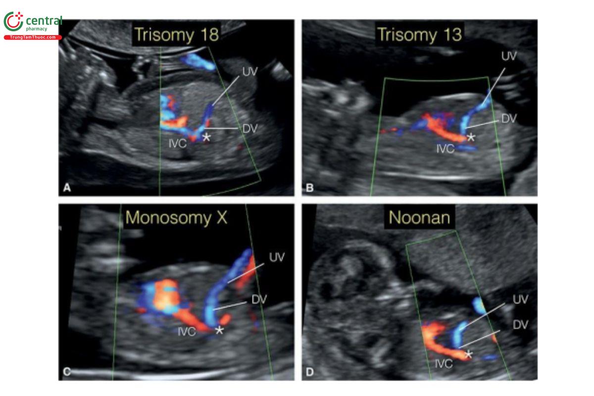  Hình 12.50: Mặt cắt dọc bụng với Doppler màu ở 4 thai nhi tương ứng bị trisomy 18 (A), trisomy 13 (B), monosomy X (C) và hội chứng Noonan (D), từ 12 đến 13 tuần tuổi. Lưu ý, tất cả 4 thai nhi (A – D) đều cho thấy ống tĩnh mạch (DV) hoặc tĩnh mạch rốn (UV) đổ trực tiếp (dấu hoa thị) vào tĩnh mạch chủ dưới (IVC). Và tất cả các thai nhi đều có thêm các dấu hiệu khác của thể lệch bội.