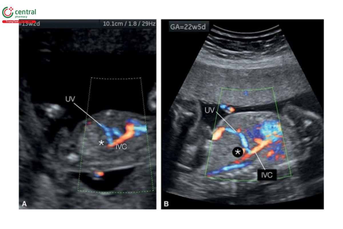 Hình 12.51: Mặt cắt dọc bụng với Doppler màu ở cùng một thai nhi lúc 13 tuần tuổi (A) và 22 tuần tuổi (B) cho thấy tĩnh mạch rốn (UV) đổ trực tiếp vào (dấu hoa thị) tĩnh mạch chủ dưới (IVC). Không phát hiện thêm dị tật nào khác và nhiễm sắc thể đồ thai nhi bình thường. Chẩn đoán được xác nhận lúc 22 tuần tuổi (B). Hệ thống tĩnh mạch cửa phát triển bình thường và siêu âm ổ bụng sau sinh cho thấy đóng kết nối và không có dấu hiệu shunt cửa-chủ.