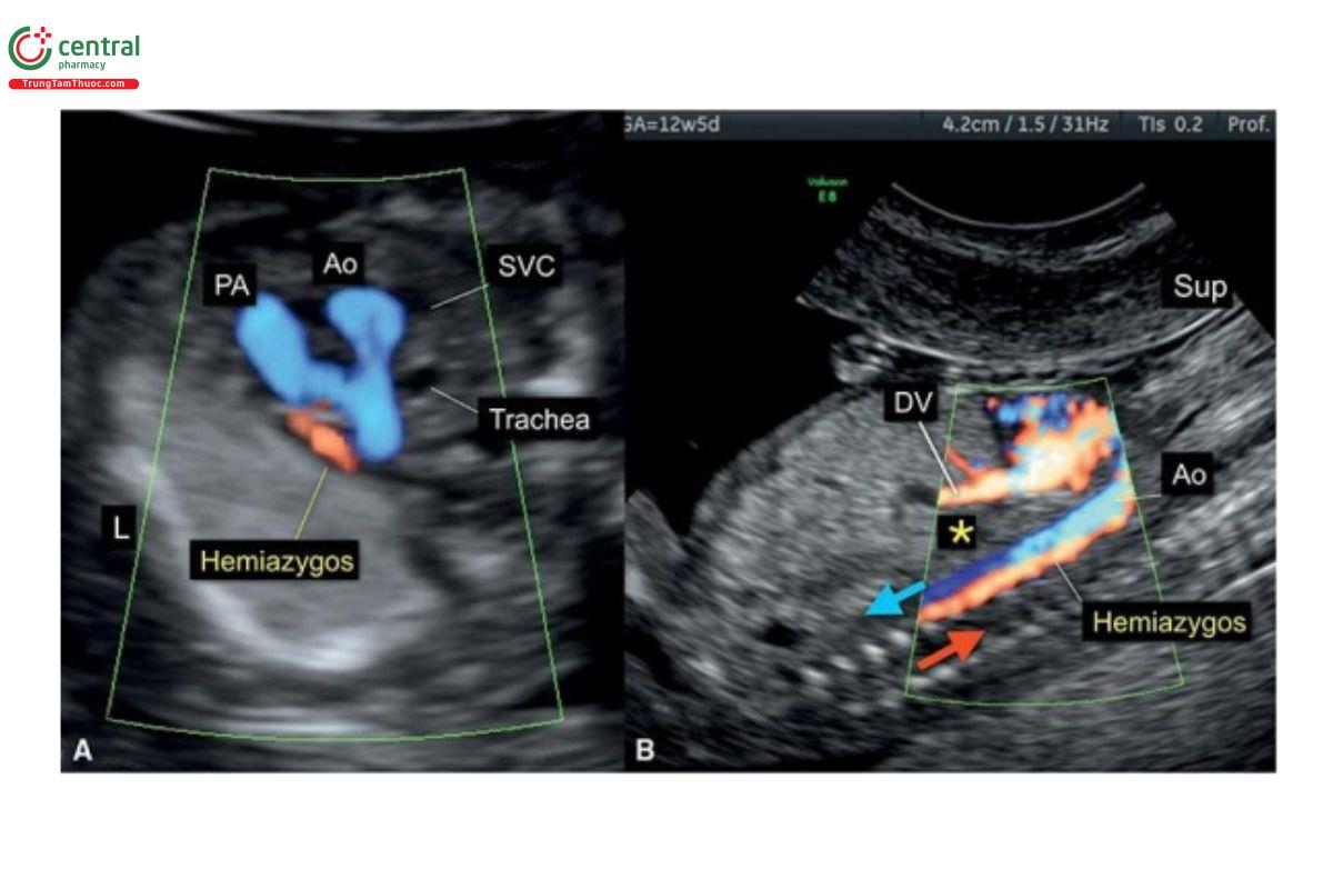 Hình 12.52: Mặt cắt ba mạch máu-khí quản (A) và mặt cắt dọc (B) với Doppler màu của thai nhi 12 tuần tuổi có liên tục tĩnh mạch bán đơn (hemiazygos continuation). Tim và dạ dày nằm bên trái nhưng ở mặt cắt bốn buồng (không được hiển thị) cho thấy dị tật tim. Mặt cắt ba mạch máu-khí quản (A) cho thấy một mạch máu không điển hình ở bên trái động mạch phổi (PA), tĩnh mạch bán đơn dãn đổ vào tĩnh mạch chủ trên bên trái. Ở mặt cắt dọc (B), động mạch chủ (Ao) và tĩnh mạch bán đơn ở cạnh nhau (side-by-side) và không thấy IVC (dấu hoa thị). Dấu hiệu gợi ý chẩn đoán tĩnh mạch bán đơn (hoặc tĩnh mạch đơn) được hỗ trợ bởi Doppler màu cho thấy hướng dòng máu ngược nhau trong động mạch chủ và tĩnh mạch bán đơn (mũi tên xanh lam và đỏ, tương ứng). Thai nhi này có đồng dạng nhĩ trái (left atrial isomerism).