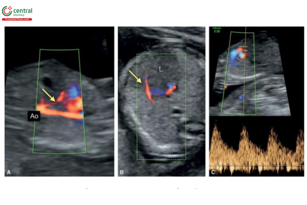 Hình 12.53: A: Mặt cắt dọc bụng thai nhi 14 tuần tuổi với Doppler màu có động mạch gan lạc chỗ (mũi tên) xuất phát từ động mạch chủ xuống (Ao) với hướng đi về phía bề mặt gan. B: Một mặt cắt ngang cơ hoành ở cùng một thai nhi cho thấy động mạch gan lạc chỗ (mũi tên) đi trên bề mặt gan (L). C: Doppler xung cho thấy vận tốc động mạch cao. Chúng tôi phát hiện tình trạng này ở thai nhi bị trisomy 21. Đôi khi, động mạch lạc chỗ này biến mất khi siêu âm theo dõi trong quý 2, như trong trường hợp này. Xem Hình 12.54.