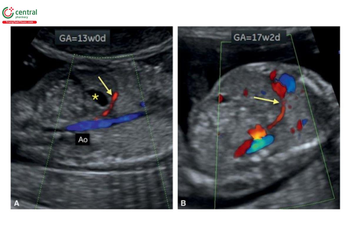Hình 12.54: A: Mặt cắt dọc bụng thai nhi 13 tuần tuổi với Doppler màu có động mạch gan lạc chỗ (mũi tên) xuất phát từ động mạch chủ xuống (Ao) với hướng đi về phía bề mặt gan. Nhìn thấy rõ dạ dày (dấu hoa thị). B: Siêu âm theo dõi lúc 17 tuần cho thấy động mạch gan lạc chỗ (mũi tên). Trong trường hợp này, nó vẫn tồn tại cho đến quý 3 và không ảnh hưởng đến kết cục sau sinh của trẻ.